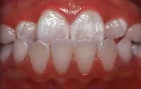 Anterior crossbite