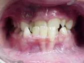 Underbite