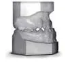 Class 3 malocclusion