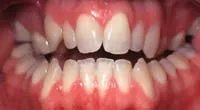 Open bite
