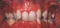 Overbite