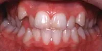 Crossbite