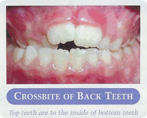 Early treatment examples