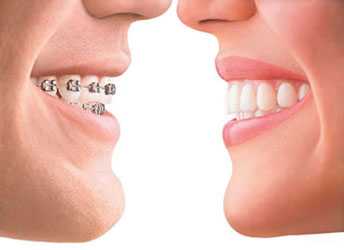 Profiles of Invisalign Patients